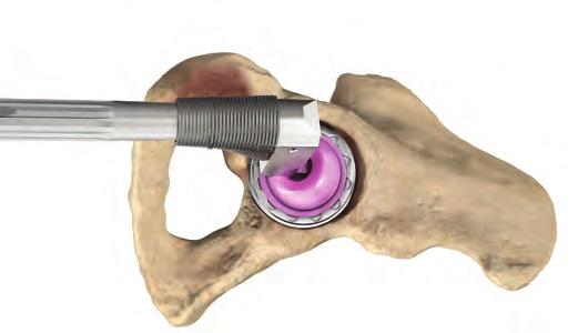 head becomes coplanar with the opening of the acetabular insert (i.e., the axis of the femoral neck is perpendicular to the insert face).