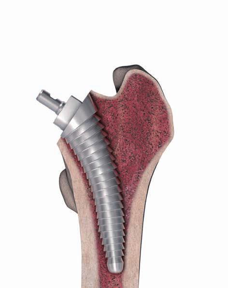 The blunt end allows you to feel the lateral cortex. Note: Make sure you are in the femoral canal before proceeding. 4.