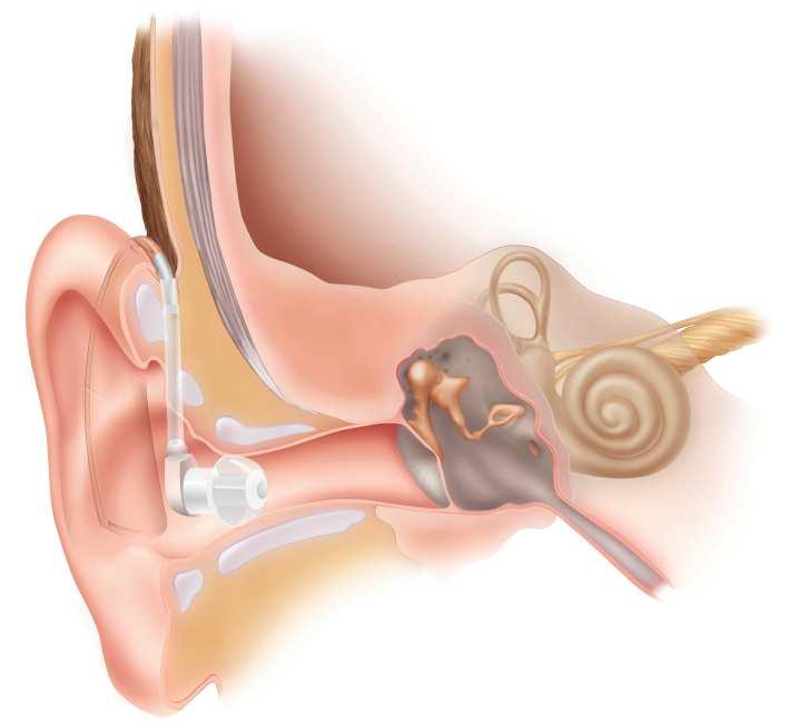 How Hearing Works: Natural Hearing 3 4 How Hearing Works: Hearing Aid 3 4 Typical