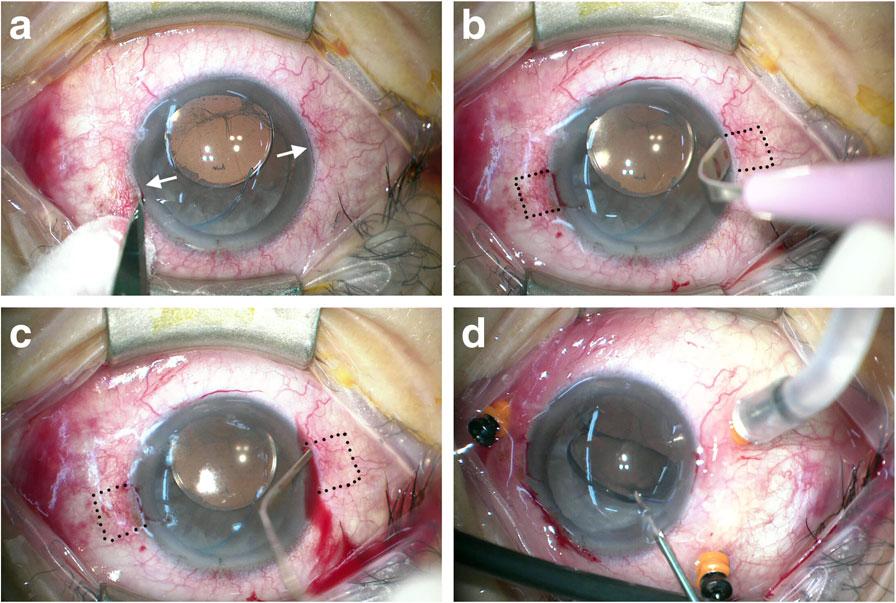 Yeung et al. BMC Ophthalmology (2018) 18:108 Page 2 of 7 sclerotomies, and omitting sutures required for sclerotomy and conjunctival wounds when compared with 20-gauge vitrectomies.