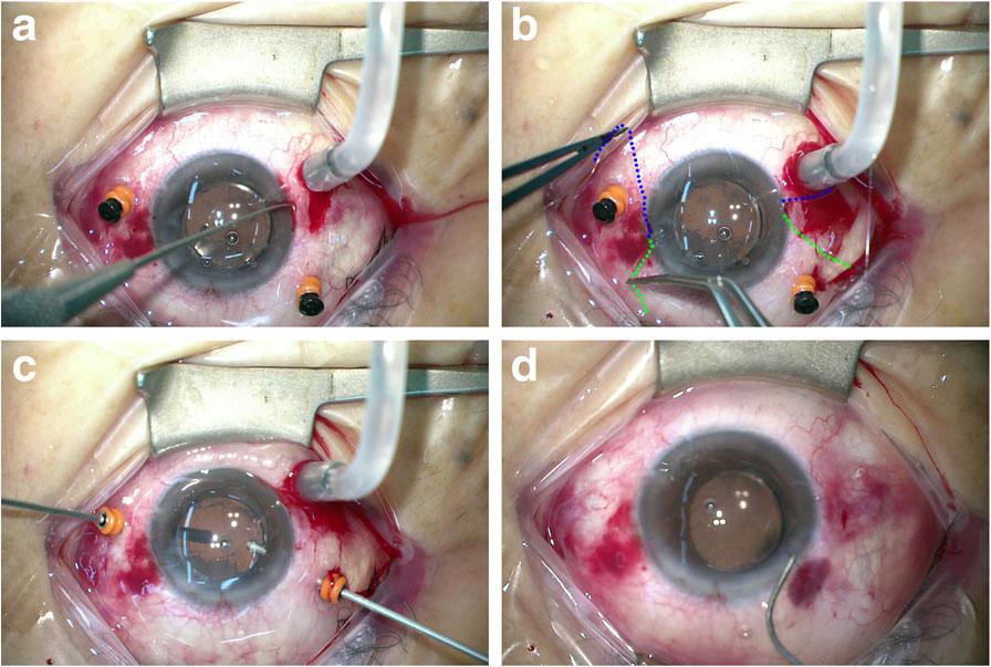 In patients who required IOL reposition, the original IOL was moved to the anterior chamber by a 23-gauge micro forceps (Fig. 1d).