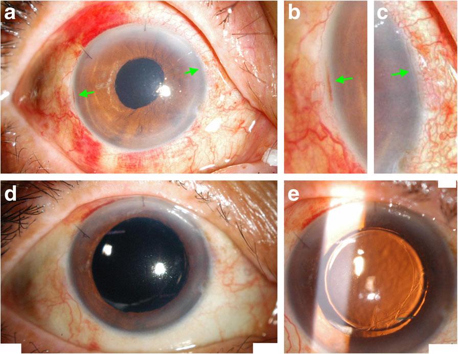 Yeung et al. BMC Ophthalmology (2018) 18:108 Page 5 of 7 preoperatively to 0.514 (Snellen equivalent 20/65) postoperatively (p < 0.001) in study patients as a whole.