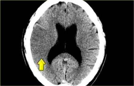 Right side CT Head Left Side http://www.radiologyassistant.