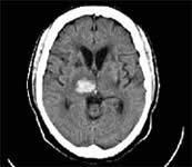 CT hemorrhage CT CT brain stem infarct http://www.google.ca/imgres?imgurl=http://www.pssjournal.