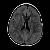 Parenchymal Assessment: MRI Middle