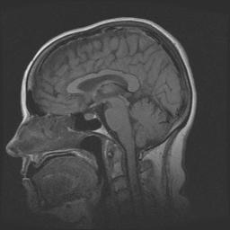 radiata Parietal lobe Occipital