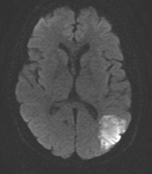 Parenchyma Assessment: MRI-Diffusion weighted image (DWI) is the MOST sensitive sequence Can be positive within minutes of stroke Produces a high