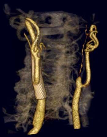 3D CTA reconstruction of left MCA total occlusion 3D CTA reconstruction image of the carotid arteries