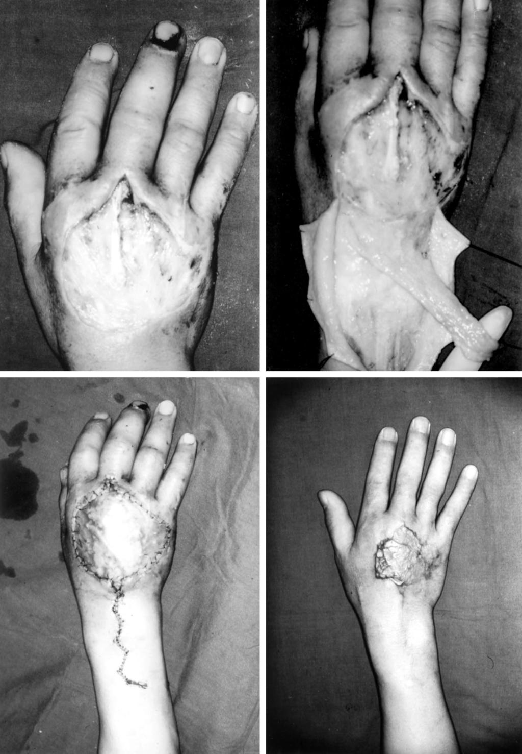 Vol. 114, No. 2 / DORSAL FOREARM FASCIOSUBCUTANEOUS FLAP 393 FIG. 4. Case 1. A 38-year old man with a crush injury on the dorsum of his right hand. (Above, left) Preoperative view.