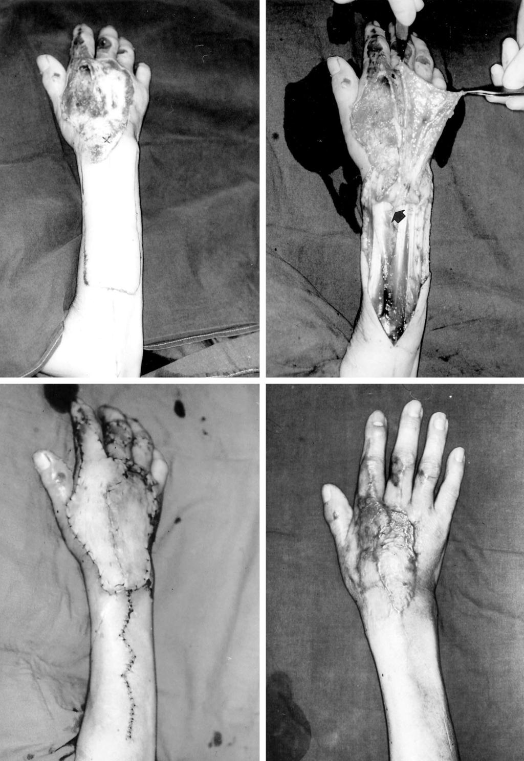 394 PLASTIC AND RECONSTRUCTIVE SURGERY, August 2004 FIG. 5. Case 2. A 62-year-old woman with a full-thickness flame burn on the dorsum of her right hand. (Above, left) Preoperative view.