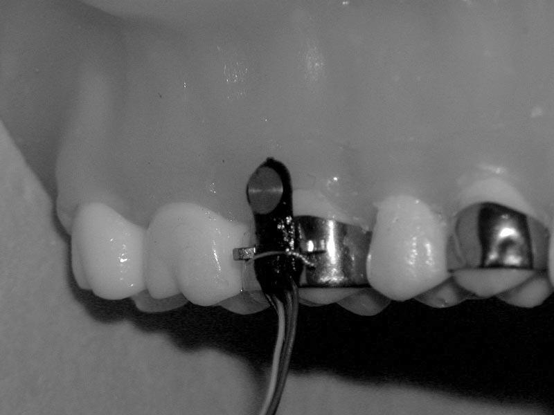 (The distance from the tooth surface is less than two mm.) which incorporated a buccal cleat and a lingual hook, was adjusted to a randomly selected upper first molar of each patient (Figure 2).