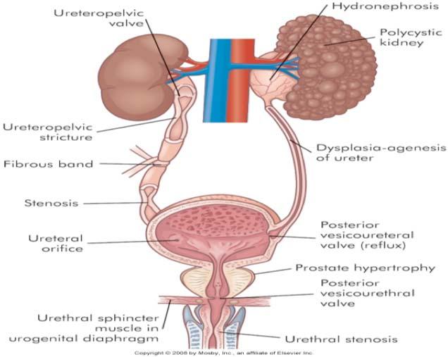 Renal Dysfunctions infection is an interference with the flow of urine along the urinary tract. It might be anatomical or functional.