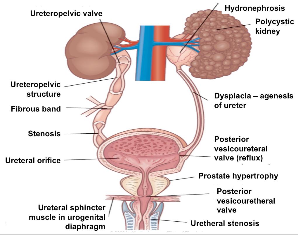 Ureteropelvic valve Hydronephrosis Polycystic kidney Ureteropelvic structure Fibrous band Dysplacia agenesis of ureter Stenosis Ureteral orifice Ureteral sphincter muscle in urogenital diaphragm