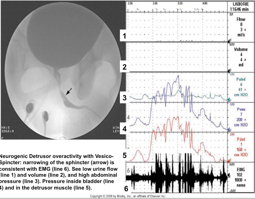 1 2 3 4 Neurogenic Detrusor overactivity with Vesico- Spincter: narrowing of the sphincter (arrow) is consistent with EMG (line 6).