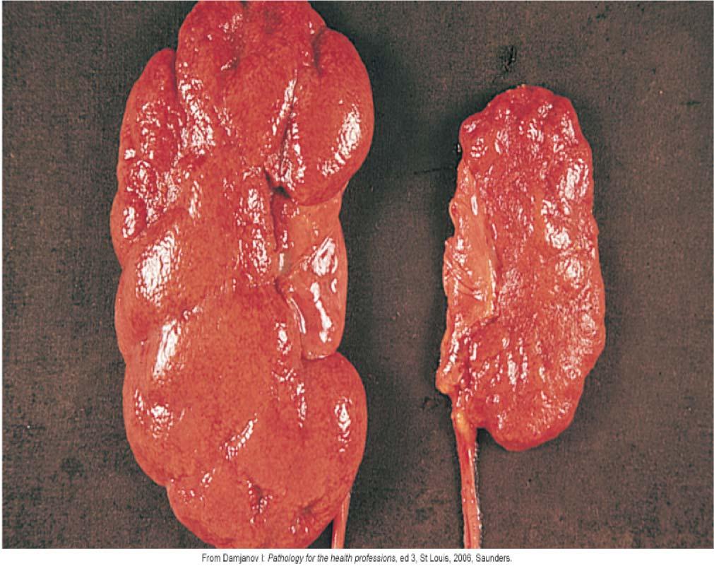 Renal Dysfunctions: Infections infection Pyelonephritis, an