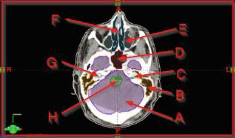 12.6 Brain (Answers) 699 Fig. 12A.1.5 A. Brainstem B. Left cochlea C. Sphenoid sinus D. Left lens E. Right orbit F. Right cochlea Fig.