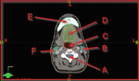 12.7 Head and Neck (Answers) 701 Fig. 12A.2.2 A. Vertebra B. Spinal cord C. Left parotid D. Trachea E. Oral cavity F.