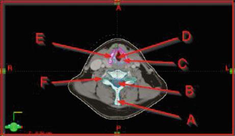 Thyroid cartilage Fig. 12A.2.5 A.