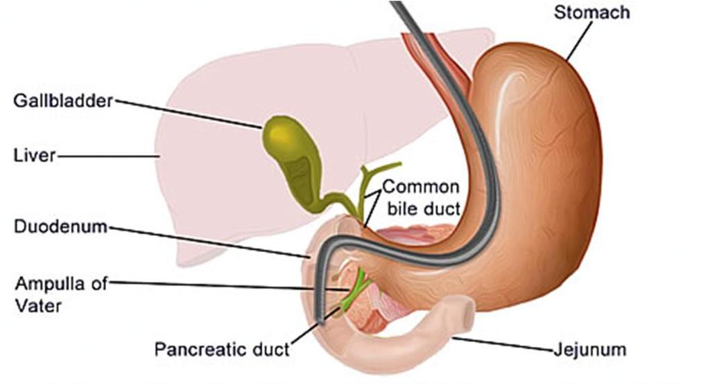 Primary Sclerosing Cholangitis Causes Shrinkage of the Bile Ducts Considered