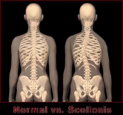 Scoliosis Lateral Curvature of the