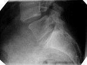 Spondylolysthesis Anterior displacement