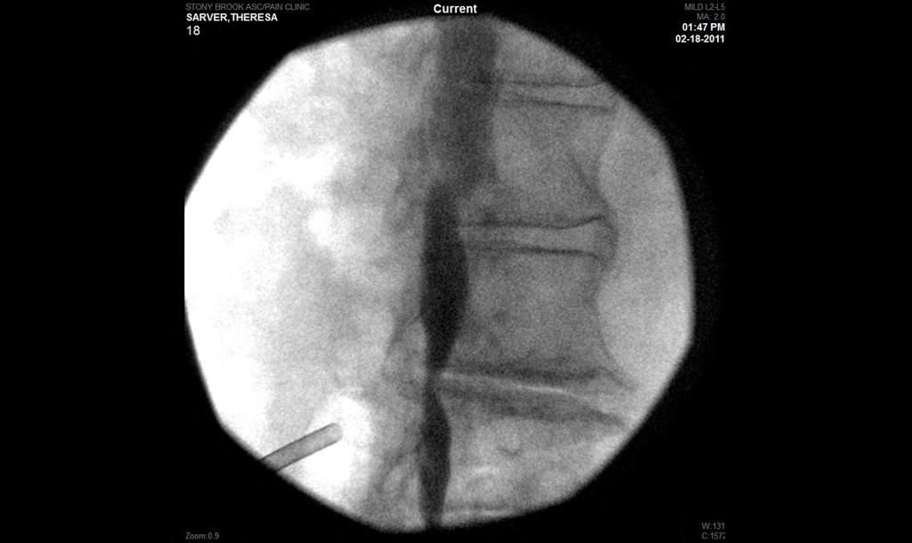 an epidural needle is placed for contrast and
