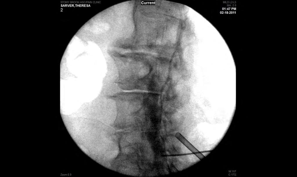 MILD A 6- gauge portal cannula is posiloned under fluoroscopy guidance adjacent to the