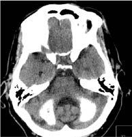 Flash Posters 6 F2062 Cognitive impairment, parkinsonism and cerebellar ataxia resulting from extensive cerebral calcinosis in a patient with Systemic Lupus Erithematosus J. Dias Ferreira, T.