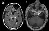 730 Flash Posters F3097 Cerebro-cardio-renal dysfunction in ischemic stroke patients K. Rasulova, B. Daminov, Y.