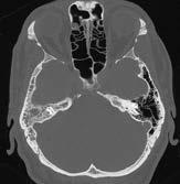 Bing-Neel syndrome is an extremely rare neurologic complication associated with central nervous system (CNS) infiltration by lymphoplasmacytoid and plasma cells.