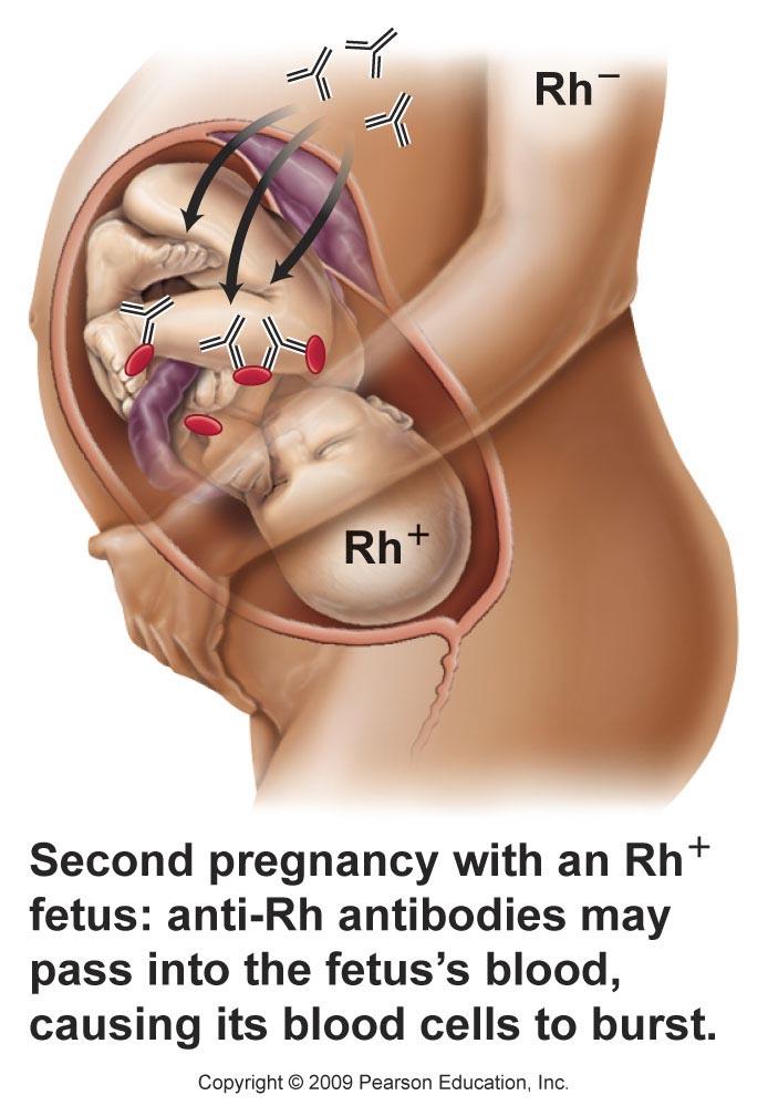 Rh Factor Blood Types Rh factor Hemolytic disease of the newborn. Anti-Rh antibodies can develop in the mother. They can cross the placenta, destroying the Rh-positive fetus s RBCs.