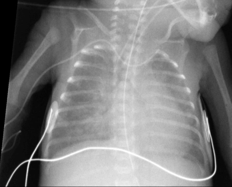 Persistent Occlusion If clearing agent does not resolve catheter