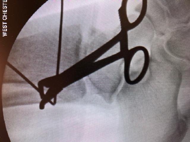 Posterior Malleolus Fracture Fixation Generally attached to the distal