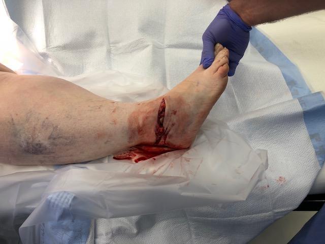 Wound Care Complications/delayed wound healing is common Venous stasis