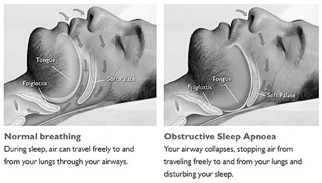 Sleep Disordered Breathing Obstructive