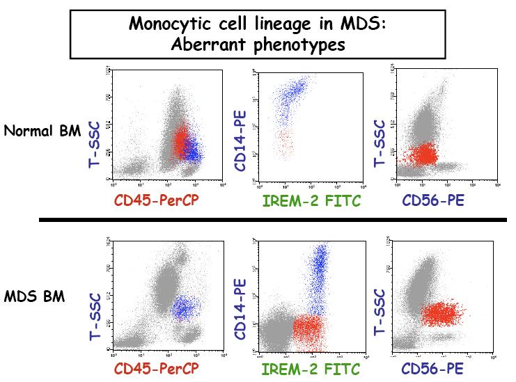A warning: CD56+ Monocytes can be found also in