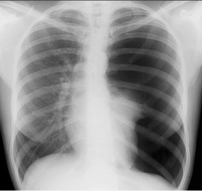 Pneumothorax cause penetration of pulmonary parenchyma bleb rupture