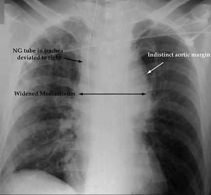 TAR - CXR wide mediastinum lost aortic