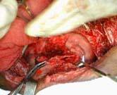 Pulmonary Contusion parenchymal injury blood/protein leak