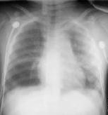 Pulmonary Contusion cont d CXR dense infiltrate 12-24 24 hrs