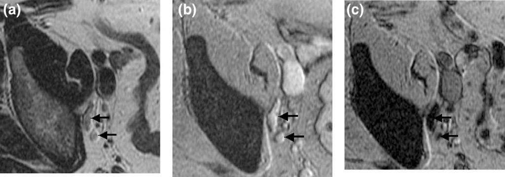 Pelvic lymph nodes for IMRT A. TAYLOR et al. 1605 Fig. 1. Axial magnetic resonance images of pelvis with lymph nodes indicated (arrows). (a) T2-weighted images without contrast.