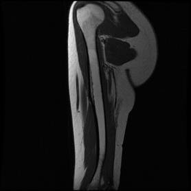 At the 3-month follow-up examination, shoulder pain severity was evaluated as 2 on visual analog scale (VAS), and no change was observed via direct radiography and MRI (Figures 5-6).