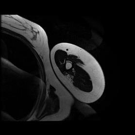 Axial T2-weighted follow-up MRI showing cortical thickening, expansion and an intracortical hyper intense area on the lateral of the left proximal humerus. Figure 6.