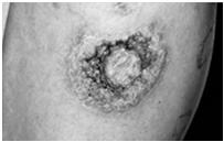 Primary Lesions Cont d Tumor - larger than 1 cm, solid lesions with depth; may be above