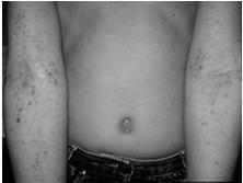 Examples: acne, impetigo Secondary Lesions Scales - shedding, dead epidermal cells that