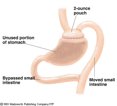 4. Drugs & Surgery for Weight Loss a) Gastric Bypass Surgery-creates surgical route from stomach to small intestine- creates life-long state of mal-absorption Normal route is to the left, the bypass