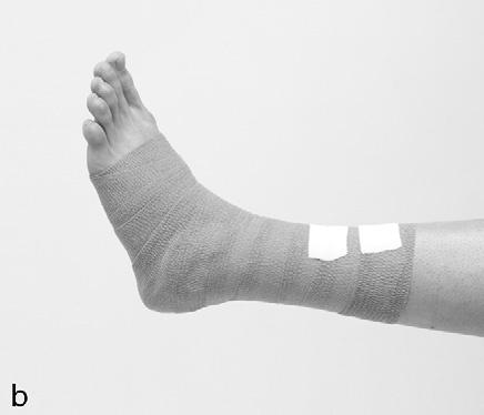 Repeat this manoeuvre, ensuring the bandage crosses at the level of the injured ligament each time.