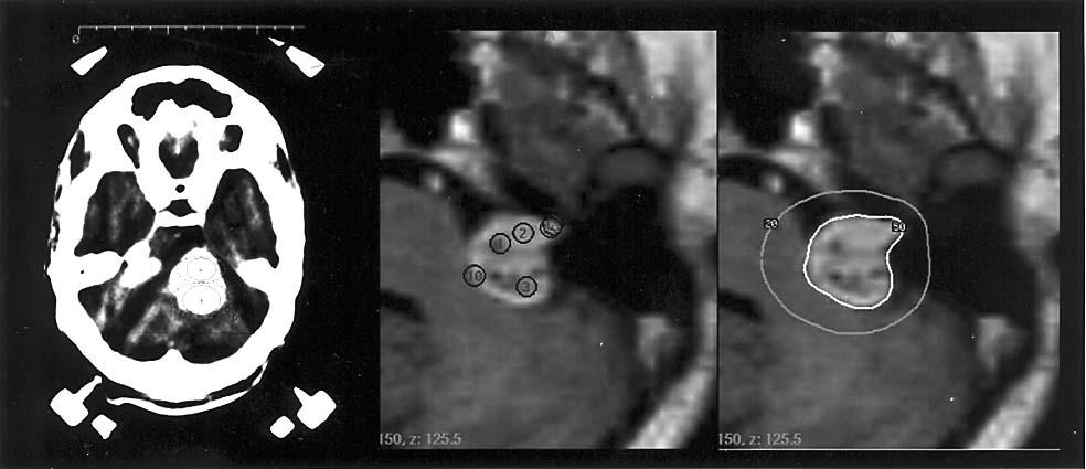 Radiosurgery for acoustic neuromas 1537 Figure 1 Illustration of the change in patient selection and treatment planning.
