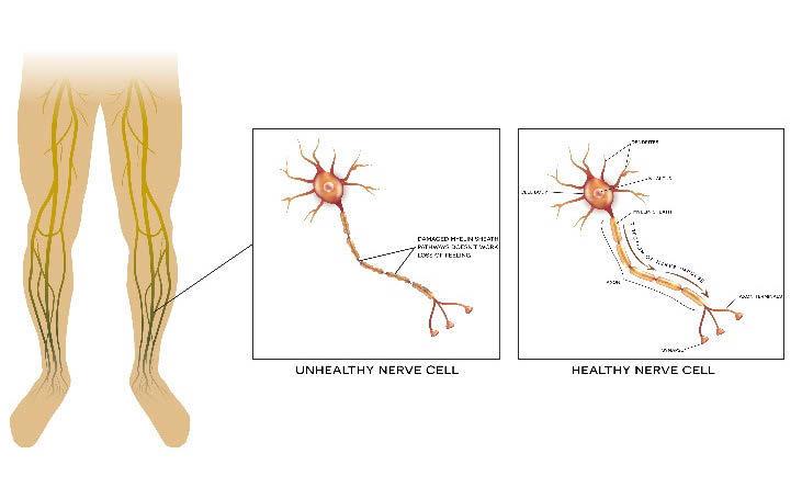 PERIPHERAL NEUROPATHY NERVE DAMAGE NERVE DAMAGE Our nervous system includes the nerves which run throughout the body, sending messages back and forth to the brain and spinal