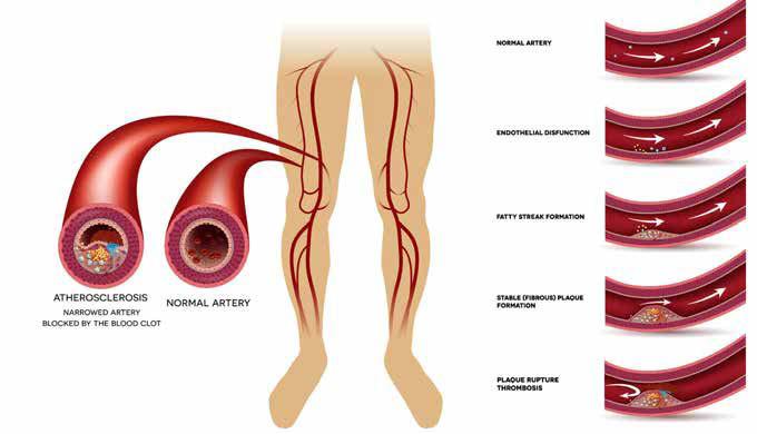 PERIPHERAL ARTERIAL DISEASE ATHEROSCLEROSIS AND BLOOD CLOT DIABETES AND CIRCULATION The circulation system includes the heart and the blood vessels.